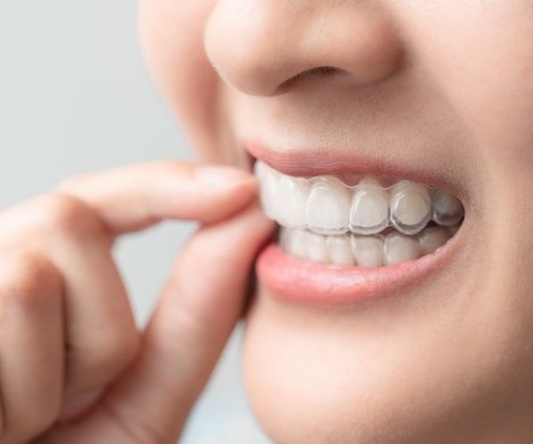 benefits-of-invisalign-regina-lakeview-dental-centre
