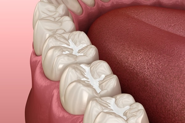 composite-fillings-regina-lakeview-dental-centre