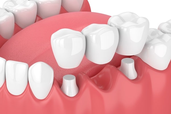 dental-bridges-regina-lakeview-dental-centre