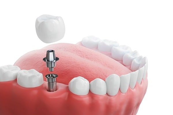 dental-implants-regina-lakeview-dental-centre
