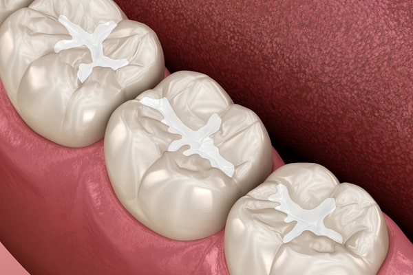fillings-composite-amalgam-regina-lakeview-dental-centre