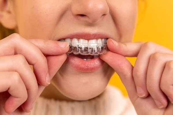 how-long-should-you-wear-a-retainer-regina-lakeview-dental-centre