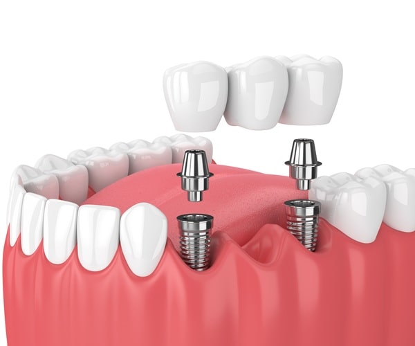 types-of-implant-solutions-regina-lakeview-dental-centre